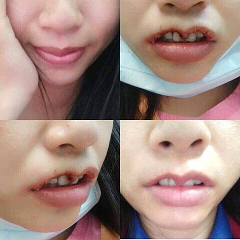 Thẩm mỹ ẩu theo trào lưu, muốn môi trái tim ai ngờ bị 'môi hở răng lạnh'- Ảnh 3. Không ít phụ nữ đã phải sửa đi sửa lại nhiều lần sau khi đi làm đẹp - Ảnh: BSCC