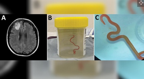 Kết quả chụp cộng hưởng từ (MRI) cho thấy người phụ nữ có một vết thương ở não (trái), sau đó các bác sĩ phát hiện có một con giun - Ảnh: LIVE SCIENCE Kết quả chụp cộng hưởng từ (MRI) cho thấy người phụ nữ có một vết thương ở não (trái), sau đó các bác sĩ phát hiện có một con giun - Ảnh: LIVE SCIENCE