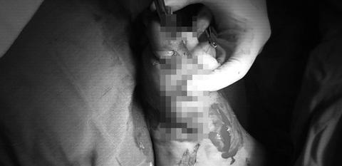 Học theo mạng tự chế pháo, trẻ em bị nát bàn tay, bỏng khắp người- Ảnh 1. Bác sĩ Bệnh viện Nhi đồng 2 xử trí vết thương bàn chân do pháo nổ cho bệnh nhi 14 tuổi - Ảnh: N.T.