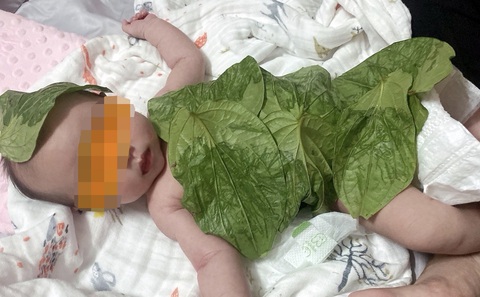 Bé bị đỏ da khi đắp lá trầu - Ảnh: BS ÚC NGUYỄN Bé bị đỏ da khi đắp lá trầu - Ảnh: BS ÚC NGUYỄN