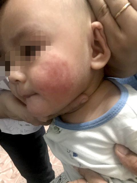Bé T. bị viêm da do đắp lá mướp - Ảnh: BS ÚC NGUYỄN Bé T. bị viêm da do đắp lá mướp - Ảnh: BS ÚC NGUYỄN