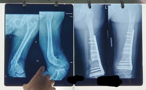 Thoái hóa khớp, có thuốc tiên nào chích vào hết hẳn không? - Ảnh 1. Thoái hóa khớp, có thuốc tiên nào chích vào hết hẳn không? - Ảnh 1.