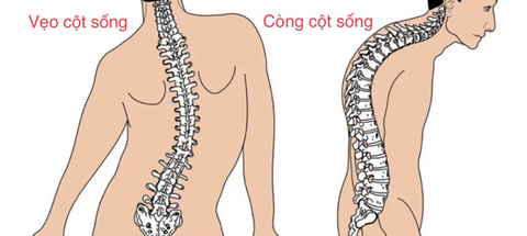 Vẹo cột sống, còng lưng có chỉnh dáng đi được không? - Ảnh 2. Vẹo cột sống, còng lưng có chỉnh dáng đi được không? - Ảnh 2.