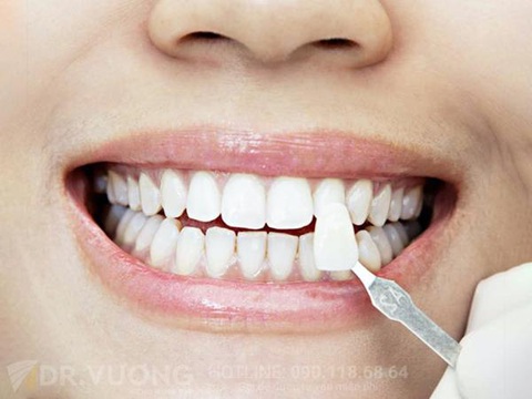 Vén màn sự thật trào lưu bọc răng sứ - Ảnh 2. Vén màn sự thật trào lưu bọc răng sứ - Ảnh 2.