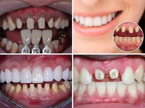 Vén màn sự thật trào lưu bọc răng sứ - Ảnh 3. Vén màn sự thật trào lưu bọc răng sứ - Ảnh 3.