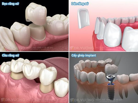 Vén màn sự thật trào lưu bọc răng sứ - Ảnh 4. Vén màn sự thật trào lưu bọc răng sứ - Ảnh 4.