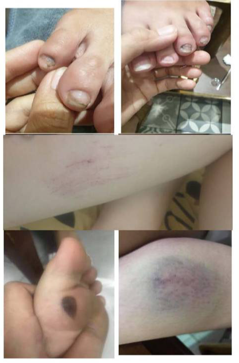 Những dấu vết bị bạo hành của U. - Ảnh: Nhân vật cung cấp Những dấu vết bị bạo hành của U. - Ảnh: Nhân vật cung cấp