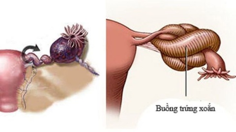 Mới 18 tháng tuổi phải cắt bỏ một buồng trứng - Ảnh 1. Mới 18 tháng tuổi phải cắt bỏ một buồng trứng - Ảnh 1.