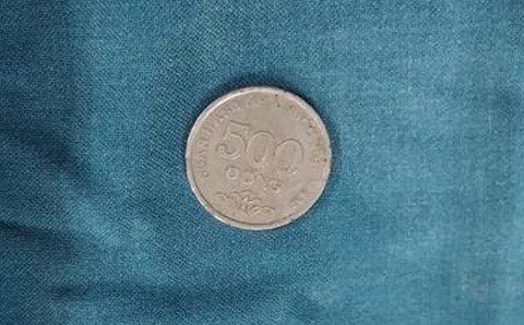 Lấy dị vật là đồng xu trong thực quản bé trai 31 tháng tuổi - Ảnh 2. Lấy dị vật là đồng xu trong thực quản bé trai 31 tháng tuổi - Ảnh 2.