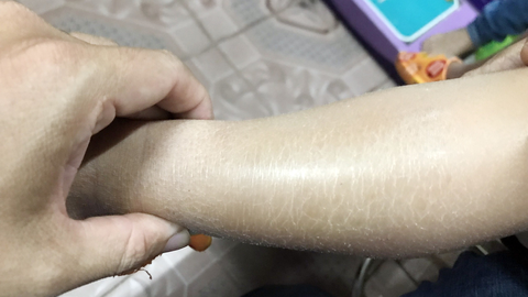 Da khô, nổi vân như vảy cá, làm sao tránh? - Ảnh 1. Da khô, nổi vân như vảy cá, làm sao tránh? - Ảnh 1.