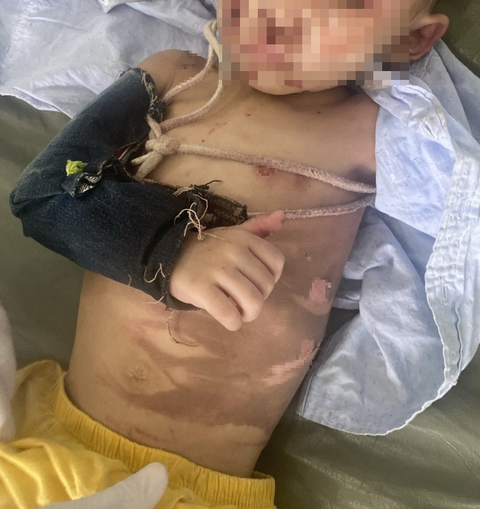 Xác minh vụ bé trai 2 tuổi bị thương khắp người ở Hóc Môn - Ảnh 2. Bé trai 2 tuổi lúc mới nhập viện - Ảnh: Bác sĩ cung cấp