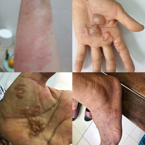 Ấu trùng giun chó mèo tạo đường hầm, làm tổ dưới da người Ấu trùng giun chó mèo tạo đường hầm, làm tổ dưới da người