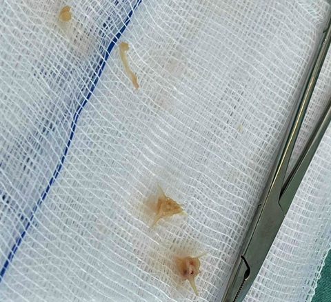 Bé gái bị thủng thực quản, nhiễm trùng máu sau ăn cháo lươn - Ảnh 1. Bé gái bị thủng thực quản, nhiễm trùng máu sau ăn cháo lươn - Ảnh 1.