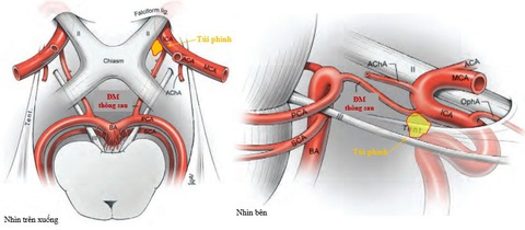 Nhiều người trẻ đột ngột “ngã quỵ” mà không biết mình bị bệnh này - Ảnh 2. Túi phình động mạch mạch não