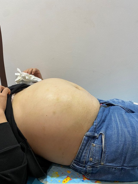 3 tháng u nhầy buồng trứng nặng 8 kg - Ảnh 2. Phát hiện khối u mới 3 tháng nhưng bụng to nhanh vì u nang nhầy buồng trứng phát triển nhanh - Ảnh: BVCC