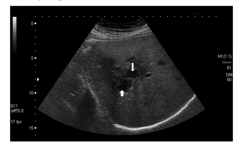 Trong 3 tháng, 172 bệnh nhân áp xe gan vô Bệnh viện Bệnh nhiệt đới, tất cả đều từ rau sống - Ảnh 2. Trong 3 tháng, 172 bệnh nhân áp xe gan vô Bệnh viện Bệnh nhiệt đới, tất cả đều từ rau sống - Ảnh 2.