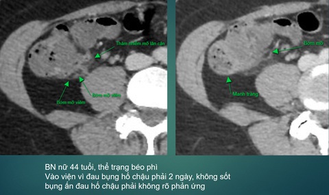 Mỡ đại tràng hoại tử dễ nhầm với viêm ruột thừa - Ảnh 1. Hình ảnh bệnh nhân viêm bờm mỡ đại tràng điều trị tại Bệnh viện E - Ảnh: BSCC