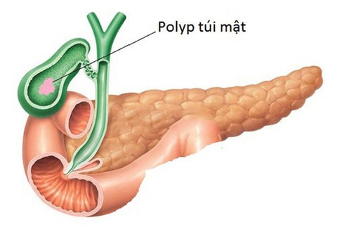 Chủ quan polyp túi mật lành tính cẩn thận thương vong - Ảnh 1. Polyp túi mật - Ảnh minh họa