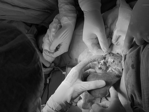 Bé gái 15 tuổi bị u buồng trứng xoắn, đau bụng dữ dội - Ảnh 1. Bé gái 15 tuổi bị u buồng trứng xoắn, đau bụng dữ dội - Ảnh 1.