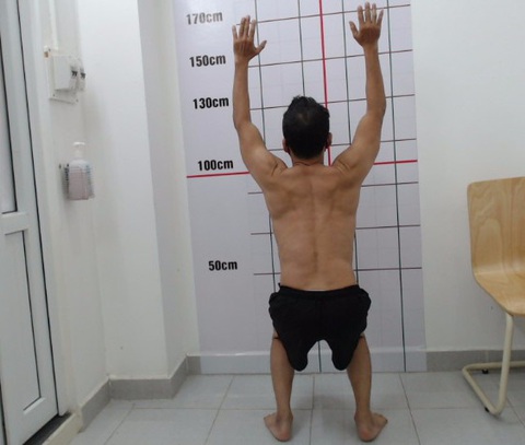 Tập gym sai cách, nhiều người trẻ bị thoát vị đĩa đệm - Ảnh 1. Một bệnh nhân bị mất đường cong sinh lý cột sống ngực và thắt lưng vì tập gym sai cách - Ảnh: Bác sĩ cung cấp