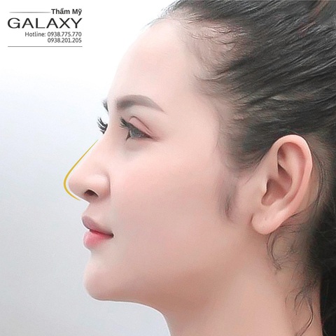 Nâng mũi đẹp hài hòa tại thẩm mỹ Galaxy - Ảnh 2. Nâng mũi đẹp hài hòa tại thẩm mỹ Galaxy - Ảnh 2.