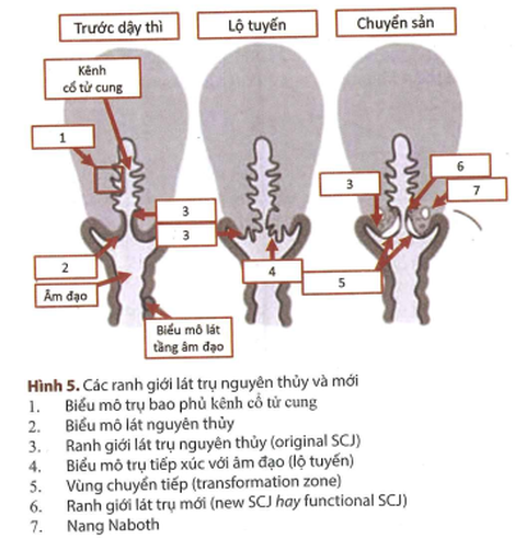 Chưa quan hệ tình dục đã viêm lộ tuyến cổ tử cung, vì sao? - Ảnh 2. Chưa quan hệ tình dục đã viêm lộ tuyến cổ tử cung, vì sao? - Ảnh 2.