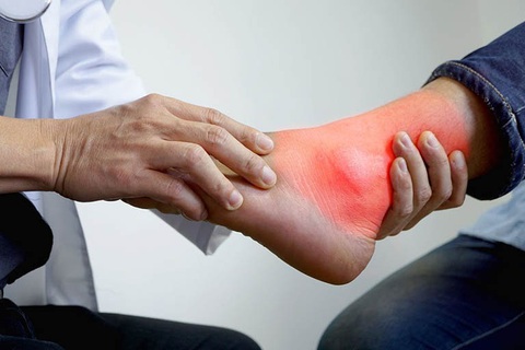 Ăn kiêng sao gút vẫn đau? - Ảnh 1. Chân sưng đau vì ăn chay trị gút - Ảnh minh họa