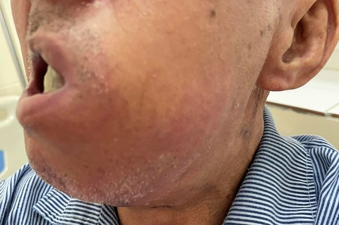Hút thuốc, uống rượu nhiều người đàn ông bị ung thư lợi chiếm toàn bộ khoang miệng - Ảnh 2. Khối ung thư lợi che lấp khoang miệng bệnh nhân