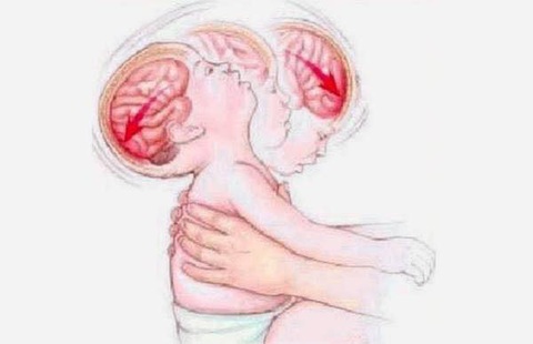Rung lắc trẻ sơ sinh nguy hiểm thế nào? - Ảnh 3. Rung lắc trẻ sơ sinh nguy hiểm thế nào? - Ảnh 3.