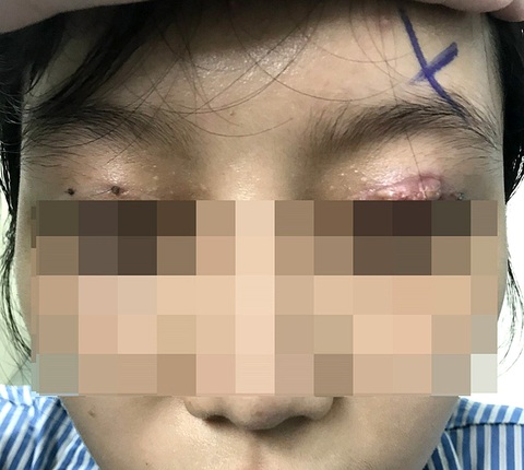 Dẹp thẩm mỹ dỏm - Ảnh 1. Một nữ bệnh nhân phải nhập viện điều trị vì bị tổn thương mắt sau khi làm đẹp tại cơ sở thẩm mỹ chui - Ảnh: Bệnh viện cung cấp