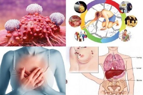 Tại sao người béo phì dễ bị ung thư hơn người bình thường? - Ảnh 1. Béo phì và một số bệnh ung thư dễ mắc - Ảnh: BSCC