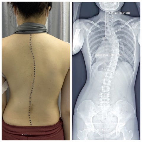 Cảnh báo học sinh, sinh viên cột sống cong chữ S, lồng ngực biến dạng - Ảnh 1. Cảnh báo học sinh, sinh viên cột sống cong chữ S, lồng ngực biến dạng - Ảnh 1.