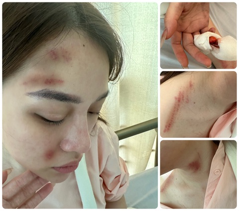 Cô gái mới sẩy thai tố bạn trai là công an quận hành hung tím người - Ảnh 1. Cô gái mới sẩy thai tố bạn trai là công an quận hành hung tím người - Ảnh 1.