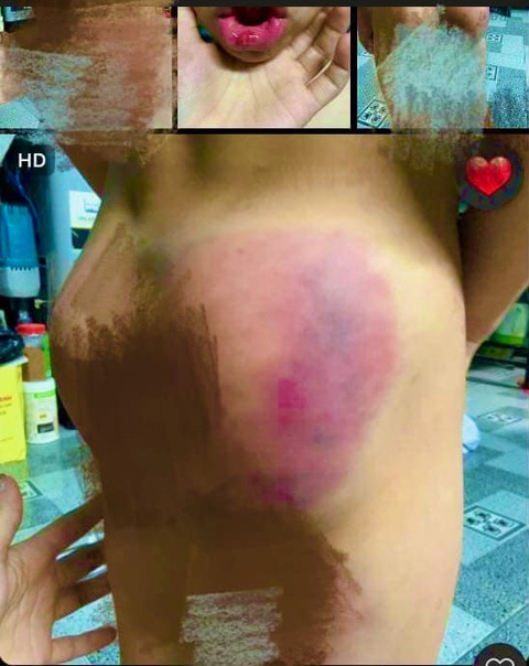 Phụ huynh tố cô giáo dùng gậy gỗ đánh trẻ bị thương nặng ở Nha Trang - Ảnh 2. Vết thương ở vùng mông và miệng trẻ - Ảnh chụp màn hình