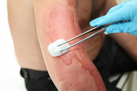 Nhiều người cho rằng ăn kiêng sẽ giúp vết bỏng để lại sẹo đẹp hơn - Ảnh minh họa Nhiều người cho rằng ăn kiêng sẽ giúp vết bỏng để lại sẹo đẹp hơn - Ảnh minh họa