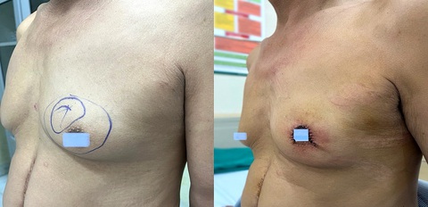 Bệnh nhân nam mắc phì đại tuyến vú - Ảnh: BVCC Bệnh nhân nam mắc phì đại tuyến vú - Ảnh: BVCC
