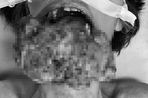 Chỉ ăn thực dưỡng chữa bệnh, khối u lên kích cỡ khủng ở môi người phụ nữ - Ảnh 1. Chỉ ăn thực dưỡng chữa bệnh, khối u lên kích cỡ khủng ở môi người phụ nữ - Ảnh 1.