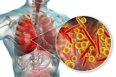 20% ca viêm phổi cộng đồng có thể do vi khuẩn Mycoplasma: Phòng cách nào? - Ảnh 3. Bác sĩ cảnh báo bệnh do vi khuẩn Mycoplasma nếu không được phát hiện và điều trị đúng cách sẽ gây ra những biến chứng nguy hiểm cho người bệnh và có thể lây lan rộng ra cộng đồng - Ảnh: BVCC