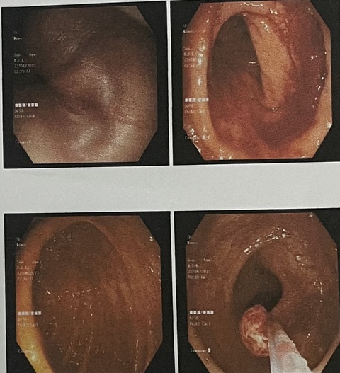 Trẻ em tiêu ra máu, cảnh báo polyp đại tràng - Ảnh 1. Hình ảnh nội soi đại tràng - trực tràng bệnh nhi tại Bệnh viện Nhi đồng Cần Thơ - Ảnh: BV cung cấp