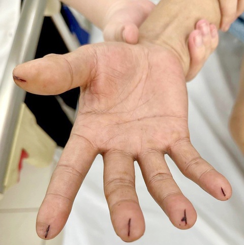 Bệnh nhân rạch đầu ngón tay để chữa đột quỵ gây nguy hiểm - Ảnh: BVCC Bệnh nhân rạch đầu ngón tay để chữa đột quỵ gây nguy hiểm - Ảnh: BVCC