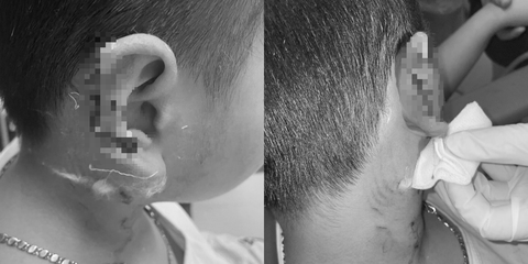 Bé trai bị chó Phú Quốc cào gây biến dạng vành tai - Ảnh: Bệnh viện cung cấp Bé trai bị chó Phú Quốc cào gây biến dạng vành tai - Ảnh: Bệnh viện cung cấp