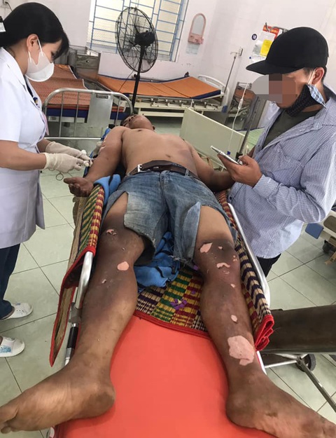 Cắt trộm cáp điện, người đàn ông bị phóng điện bỏng nặng, nằm 'vắt vẻo' trên trạm biến áp - Ảnh 3. Người đàn ông bị bỏng nặng được đưa vào bệnh viện điều trị - Ảnh: Điện lực Hiệp Đức