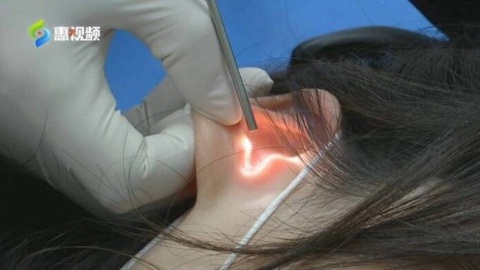 Cô gái thủng màng nhĩ vì người yêu hôn - Ảnh 1. Người phụ nữ được chẩn đoán thủng màng nhĩ sau khi được người yêu hôn.