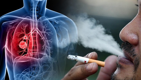 Hút thuốc là yếu tố nguy cơ hàng đầu với bệnh ung thư phổi. Hút thuốc là yếu tố nguy cơ hàng đầu với bệnh ung thư phổi