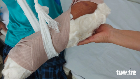 Ngư dân bị đánh trên tàu cá ở Kiên Giang nói gì? - Ảnh 2. Ông T. bị bạn đi cùng tàu cá đánh gãy tay - Ảnh: C.CÔNG