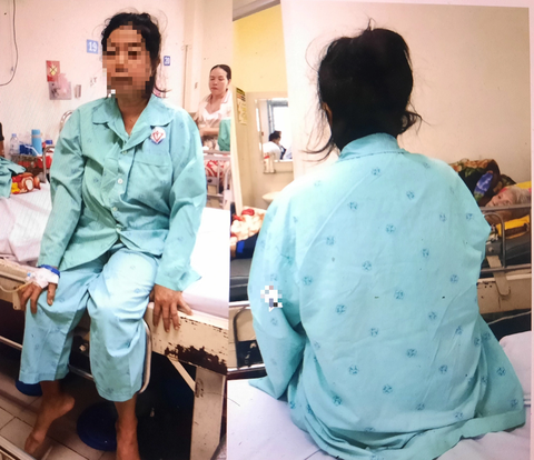7 giờ căng thẳng phẫu thuật cho bệnh nhân bị vẹo cột sống nặng 15 năm - Ảnh 1. Sau khi mổ xong, bệnh nhân bớt đau thắt lưng, dáng người thẳng, hết còng, vẹo cột sống - Ảnh: Bác sĩ cung cấp
