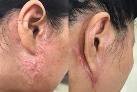 Đường mổ căng da mặt sai khiến gây sẹo lồi, mất thẩm mỹ - Ảnh: BSCC Đường mổ căng da mặt sai khiến gây sẹo lồi, mất thẩm mỹ - Ảnh: BSCC