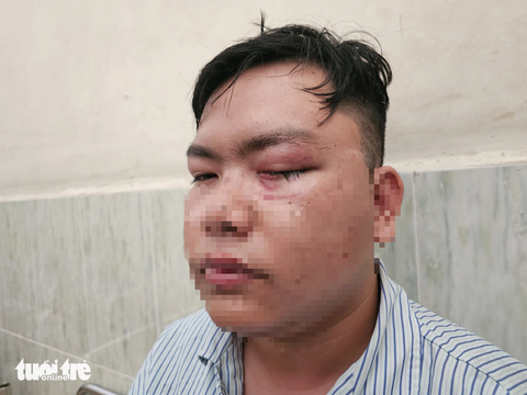 Vì sao cảnh sát giao thông không đưa người 'va' vào gậy đi cấp cứu? - Ảnh 1. Anh N. cho biết sau khi "va" vào gậy của cảnh sát giao thông, mắt trái anh phải mổ cấp cứu và hiện thị lực chỉ còn khoảng 30% - Ảnh: ĐAN THUẦN