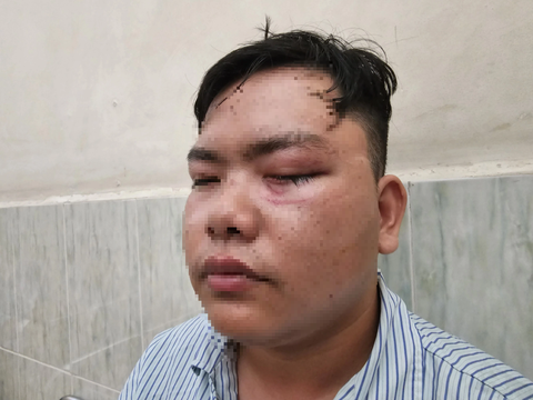 Vụ thanh niên tố bị gậy CSGT 'va' vào mắt: 'Đang làm nhiệm vụ và đã đón xe ôm chở đi' - Ảnh 2. Anh N. cho biết sau khi "va" vào gậy của cảnh sát giao thông, mắt trái anh phải mổ cấp cứu và hiện thị lực chỉ còn khoảng 30% - Ảnh: ĐAN THUẦN
