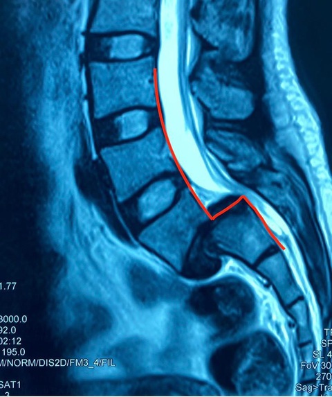 Phẫu thuật thành công cho người bệnh trượt thân sống độ IV - Ảnh 1. Phẫu thuật thành công cho người bệnh trượt thân sống độ IV - Ảnh 1.